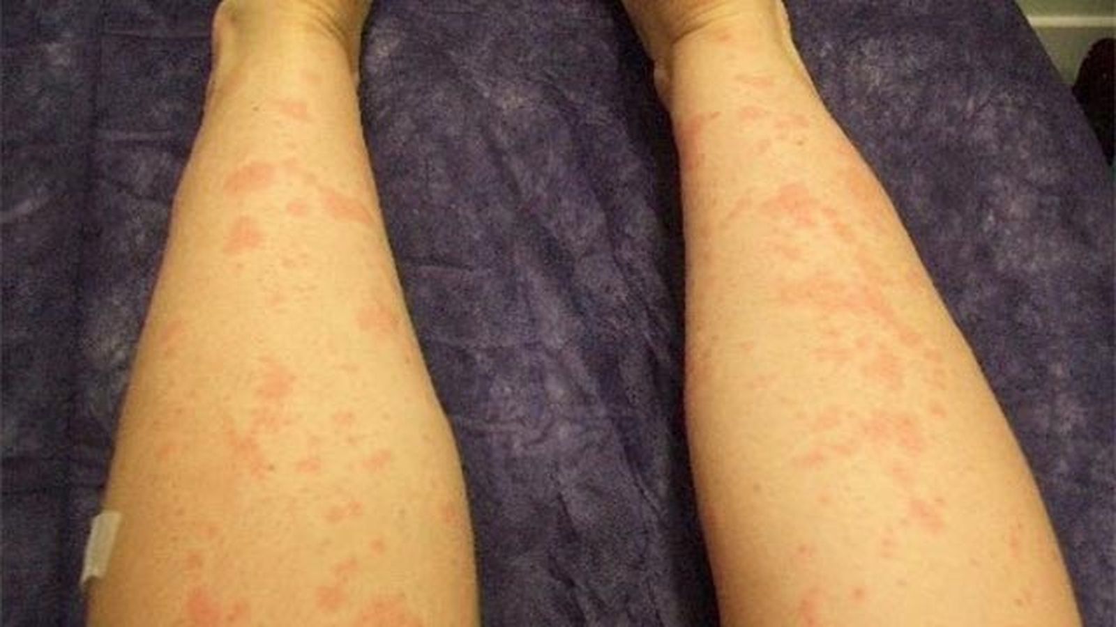 todo lo que debes saber sobre la depilacion laser urticaria todo lo que debes saber sobre la depilacion laser urticaria