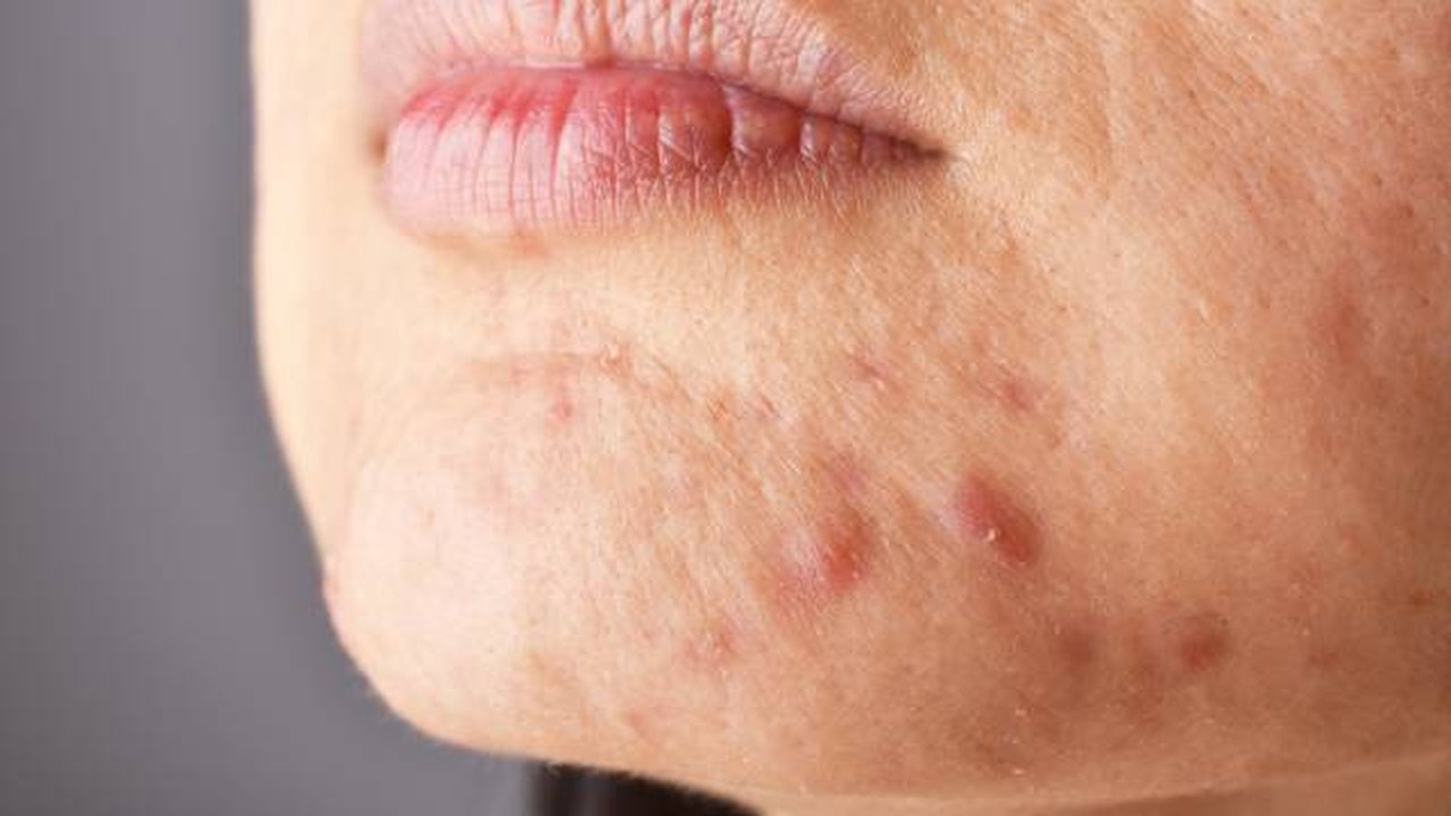 acne quistico causas tratamiento y prevencion 1 acne quistico causas tratamiento y prevencion 1