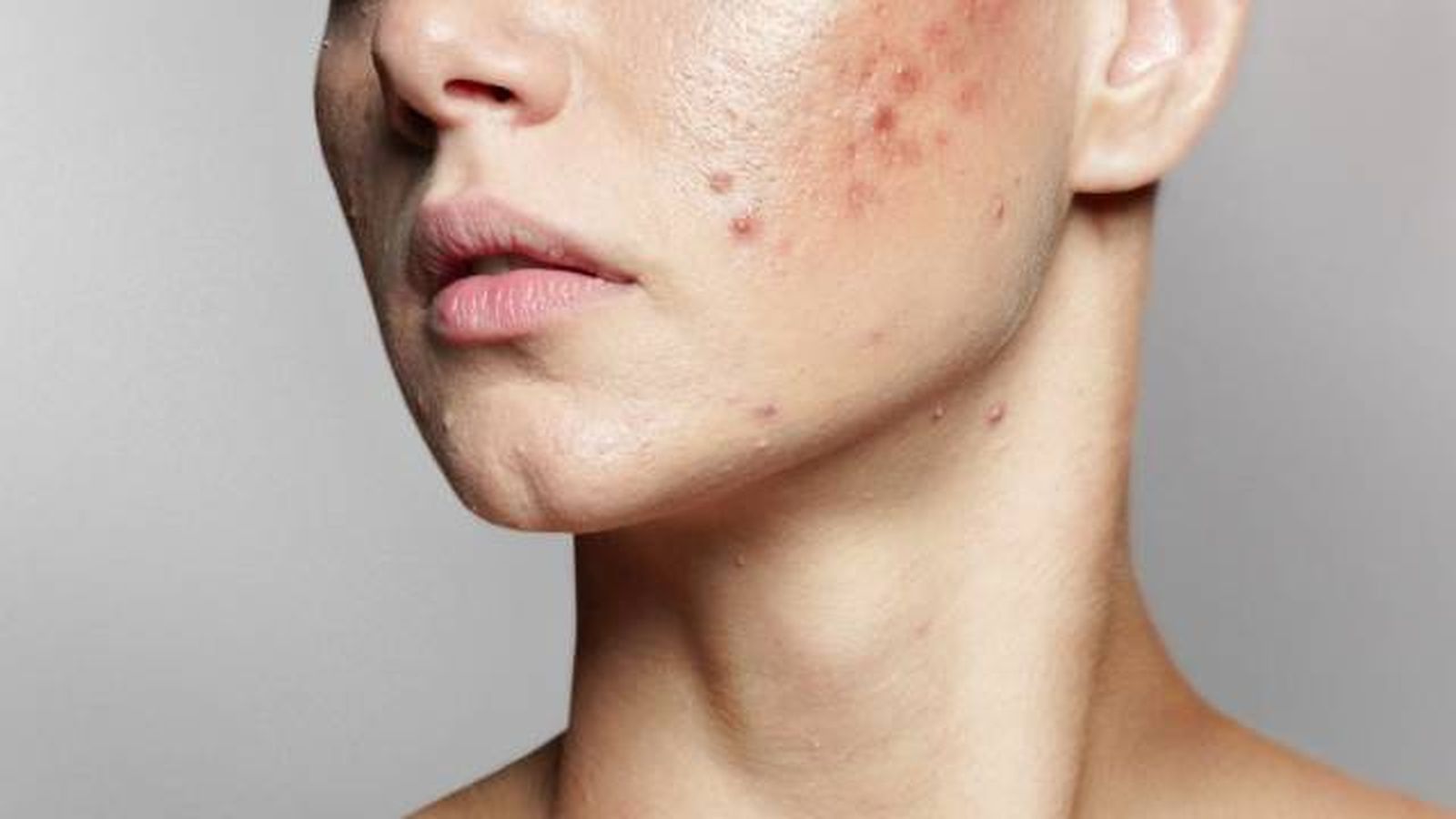 acne quistico causas tratamiento y prevencion 2 acne quistico causas tratamiento y prevencion 2