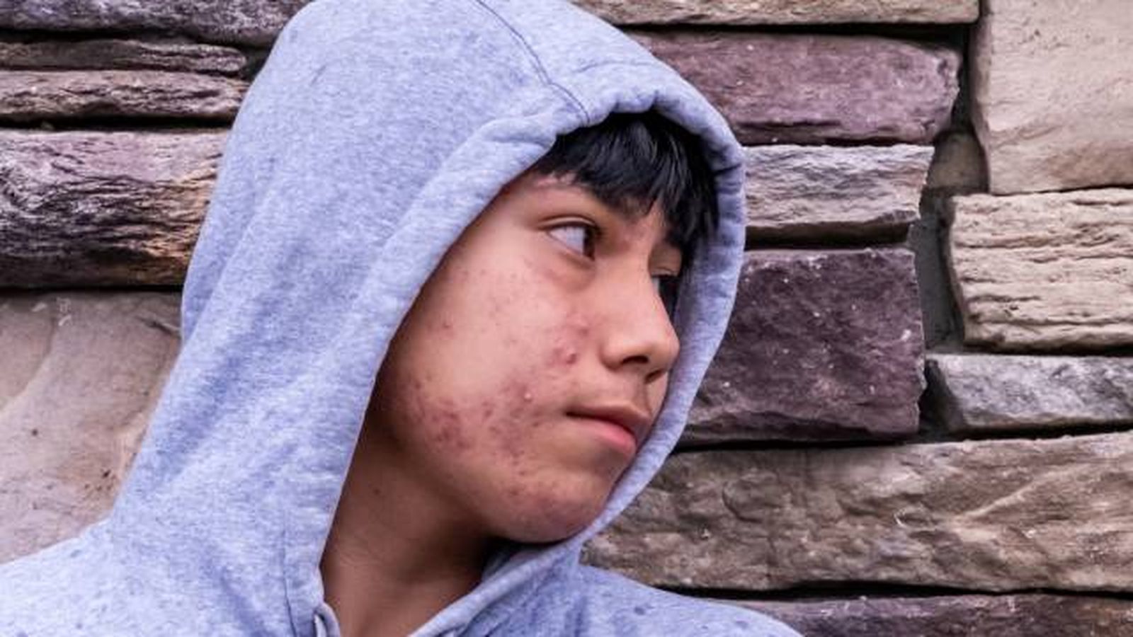 acne quistico causas tratamiento y prevencion 4 acne quistico causas tratamiento y prevencion 4