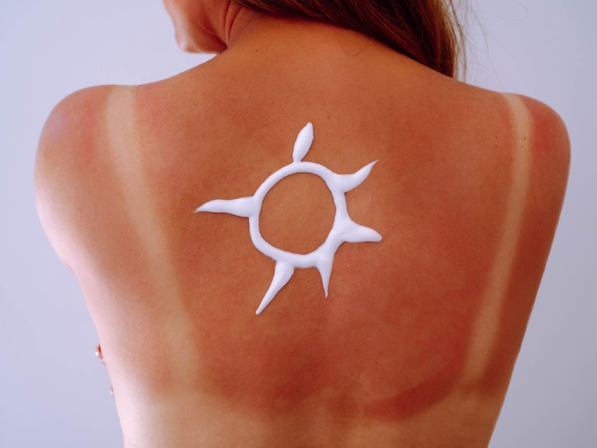 Protege siempre tu piel ante la exposición solar