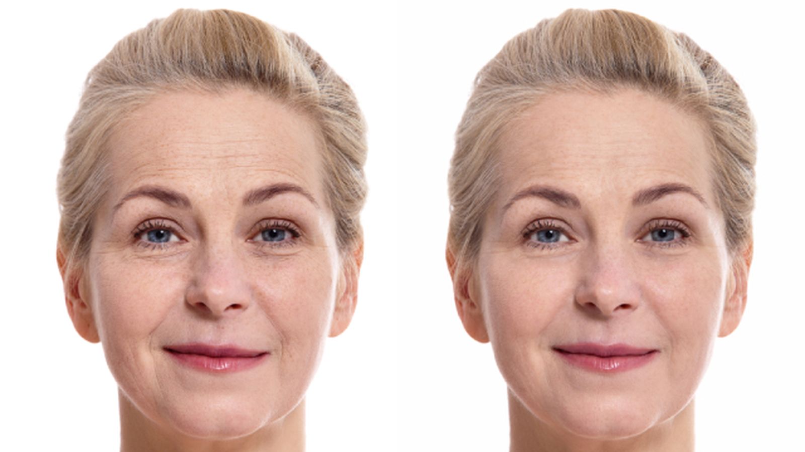 lifting facial sin cirugia antes y despues lifting facial sin cirugia antes y despues