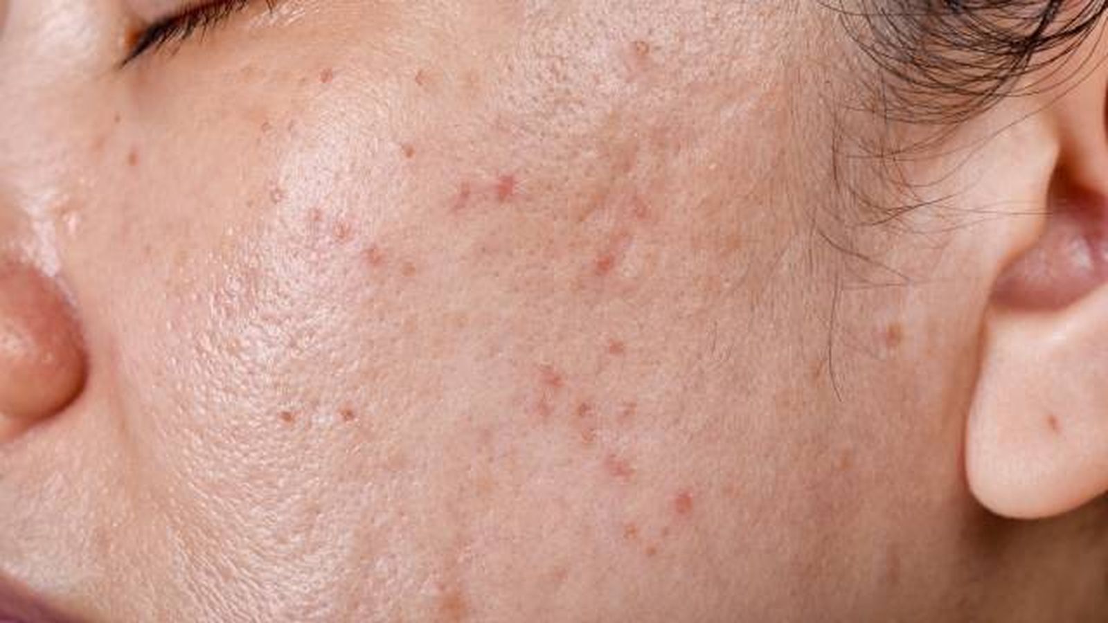 acne quistico causas tratamiento y prevencion 3 acne quistico causas tratamiento y prevencion 3