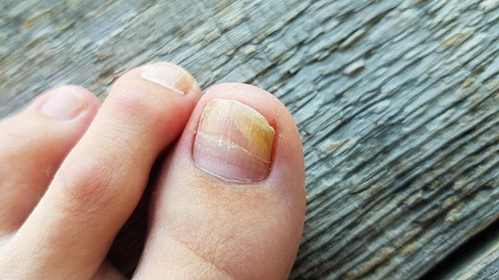 como eliminar hongos en las unas de los pies remedios 1 como eliminar hongos en las unas de los pies remedios 1