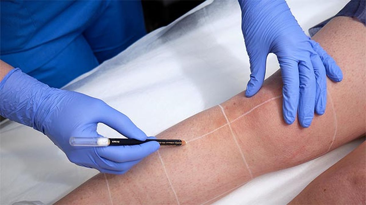 todo lo que debes saber sobre la depilacion laser 1