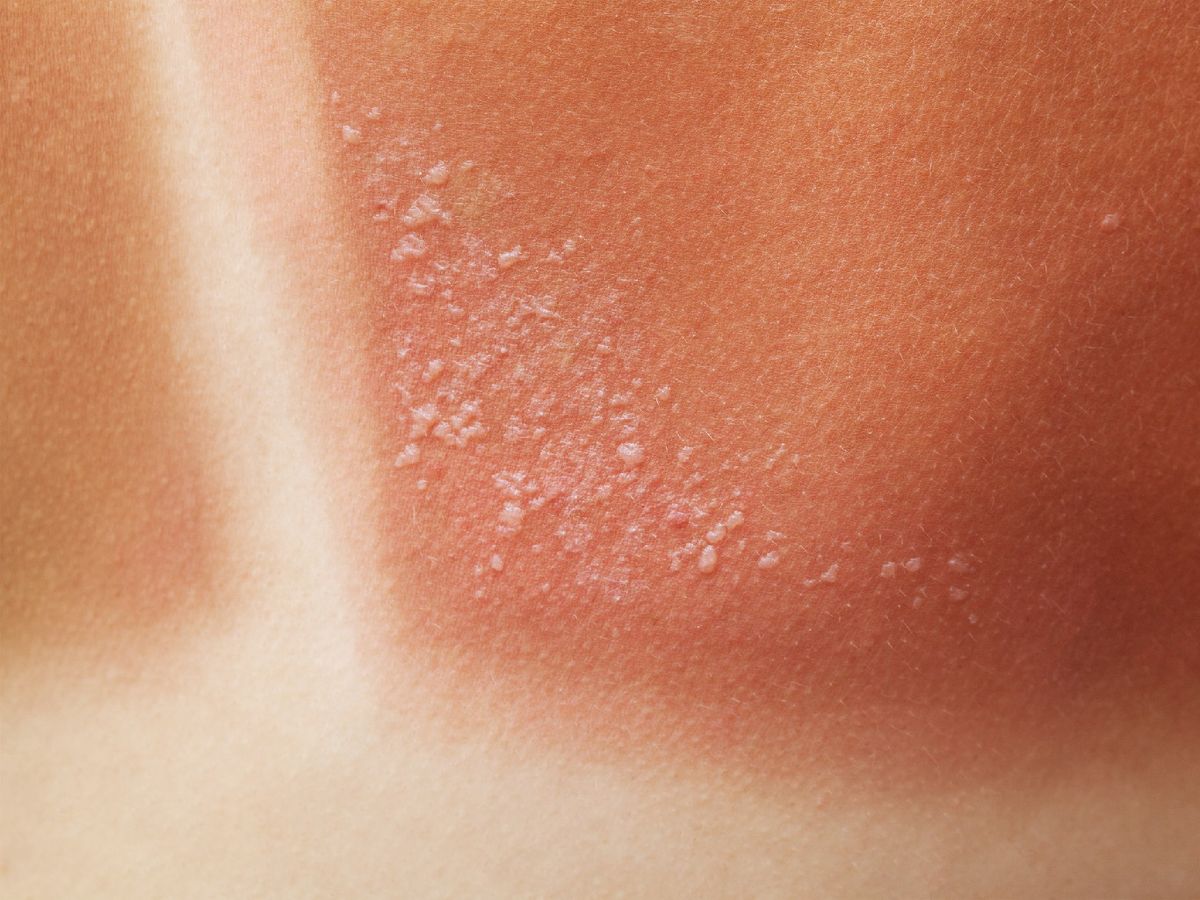 Quemadura de segundo grado superficial con pequeñas ampollas