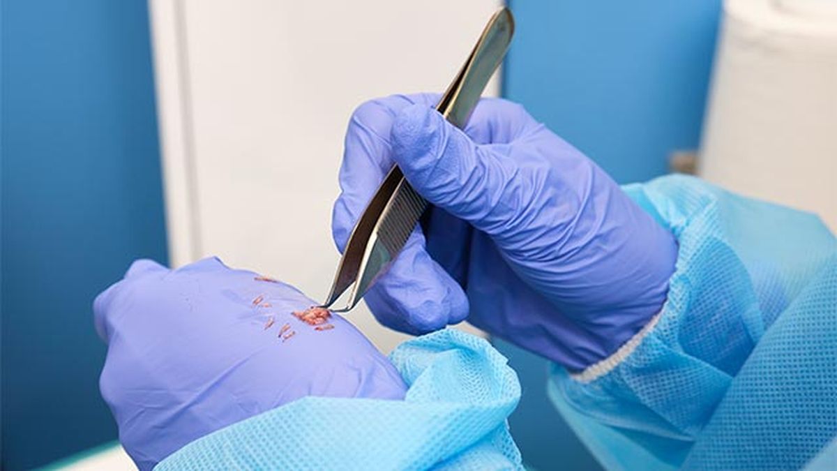 injerto capilar que es como se hace cuidados despues del tratamiento proceso