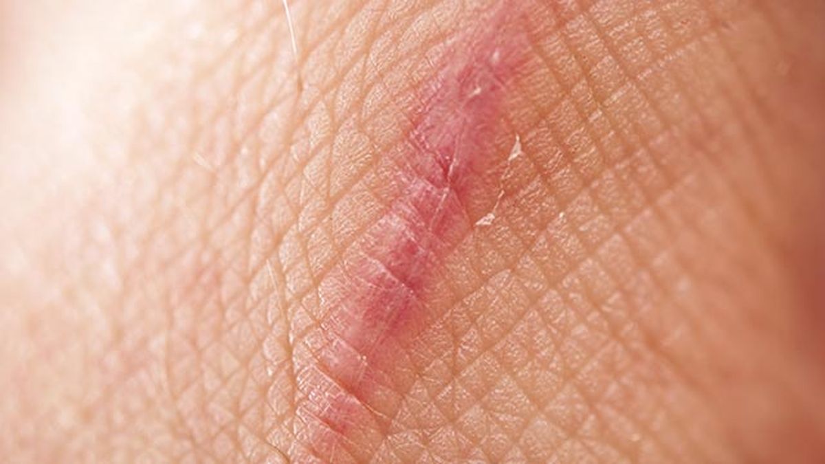 que es el acido kojico y para que sirve cicatriz