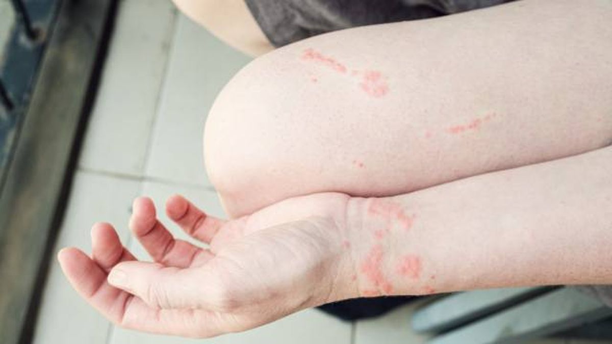 picadura carabela portuguesa