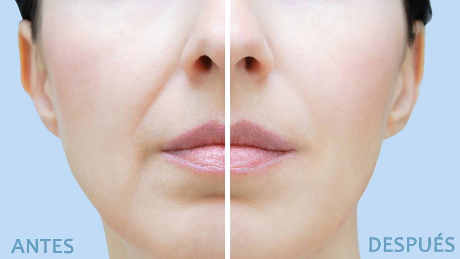 infiltraciones de acido hialuronico antes y despues infiltraciones de acido hialuronico antes y despues