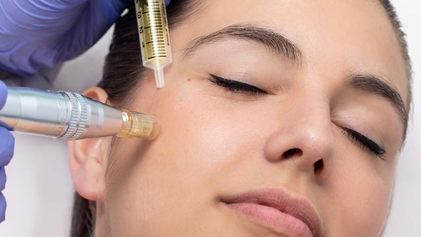 microneedling facial que es como se hace cual precio microneedling facial que es como se hace cual precio