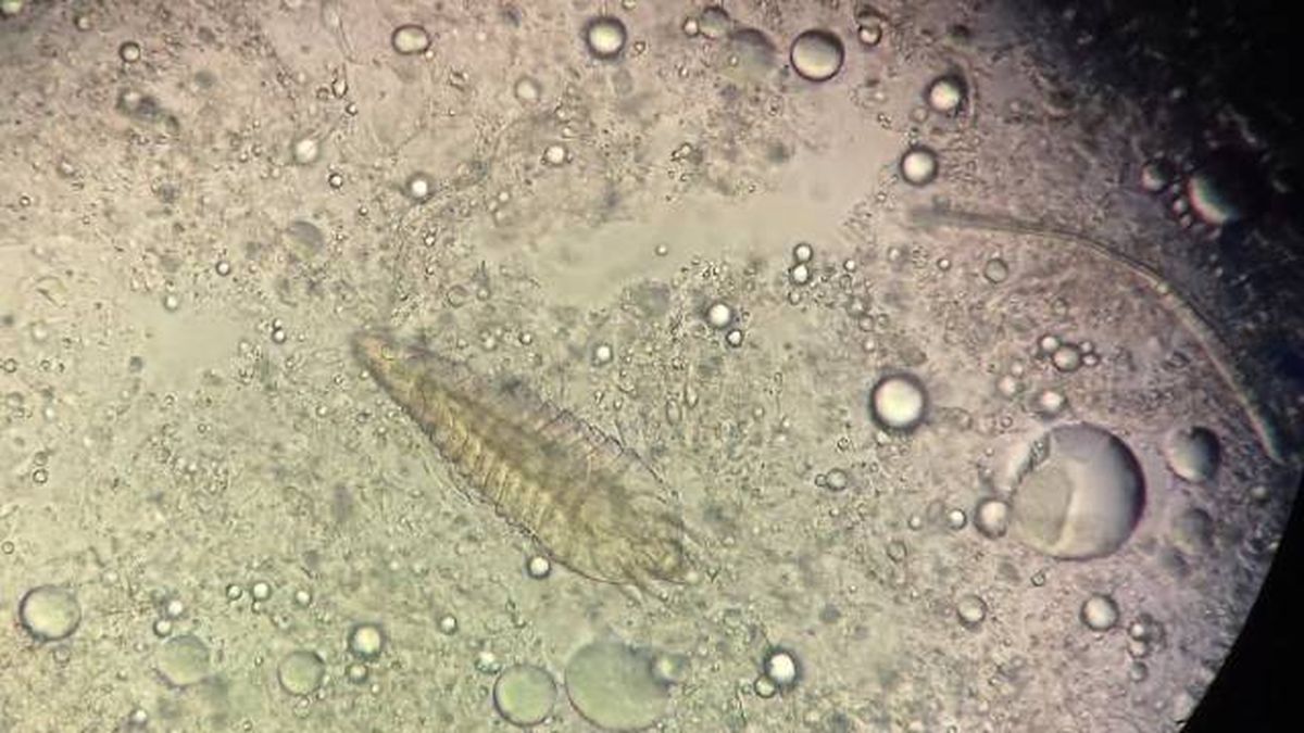 demodex folliculorum acaros de la cara