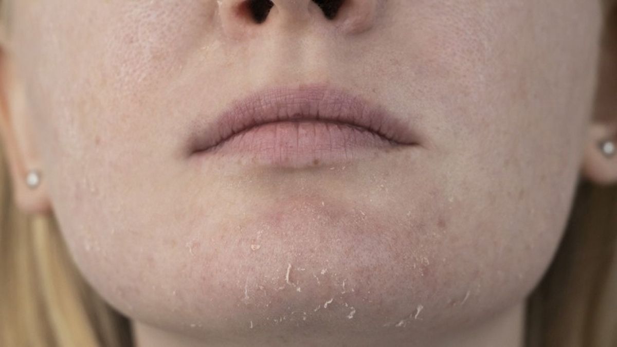 La piel seca se caracteriza por producir menos sebo que la piel normal