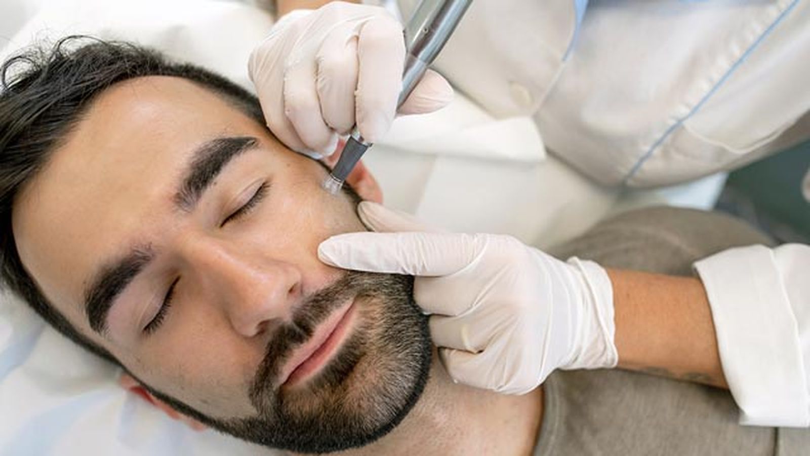 microneedling facial que es como se hace  precio microneedling facial que es como se hace  precio