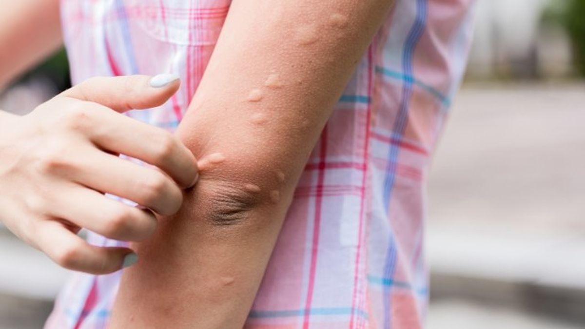 por que pican los mosquitos