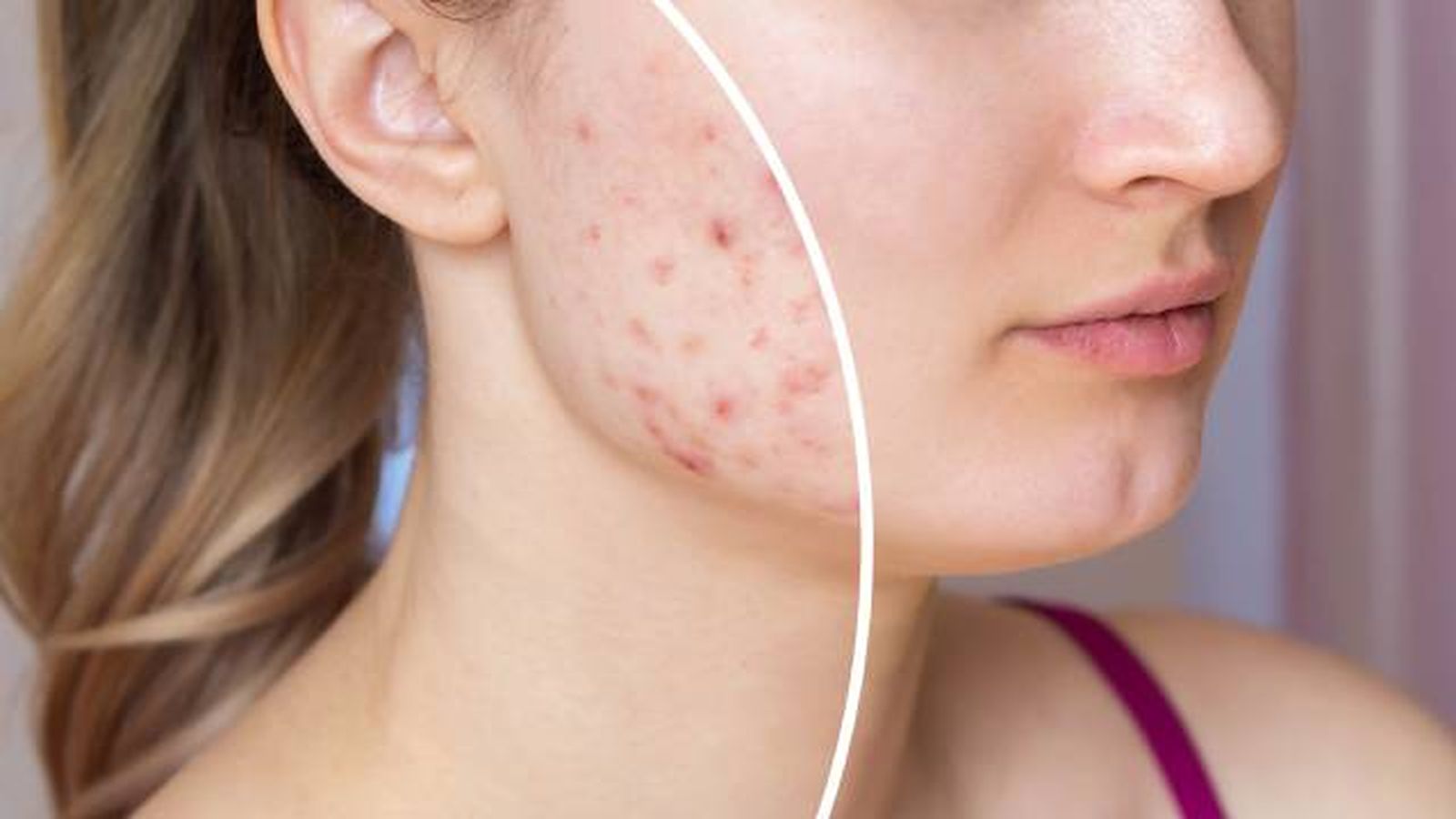 tratamiento para el acne