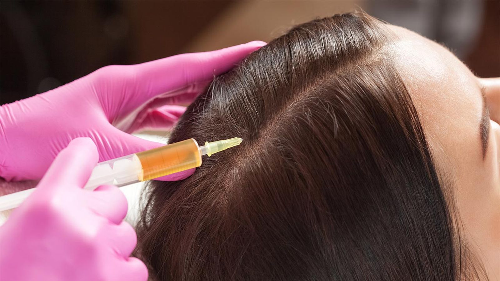 belleza PRP capilar tratamiento plasma rico plaquetas caida cabello inyecciones belleza PRP capilar tratamiento plasma rico plaquetas caida cabello inyecciones