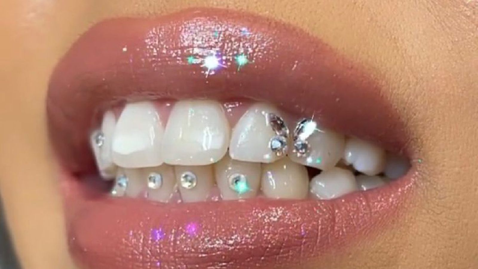 Piercings dentales