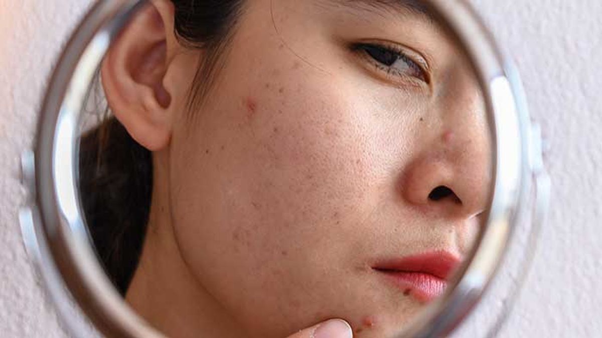 tipos manchas solares tratamientos lentigo seniles